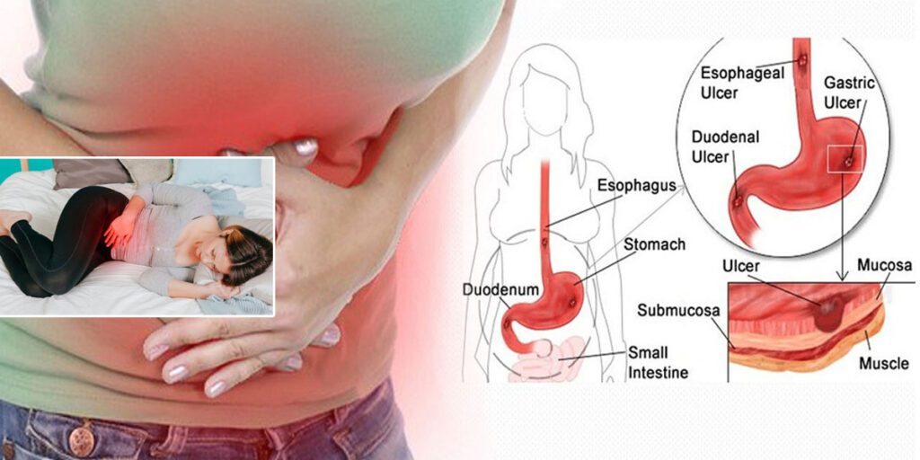 कसरी हुन्छ अल्सर, के छ उपचार ?